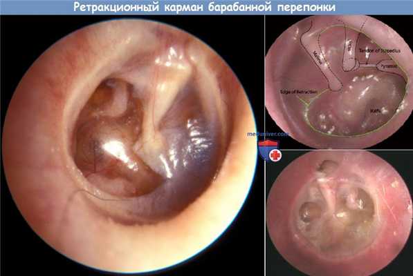 Ретракционный карман барабанной перепонки