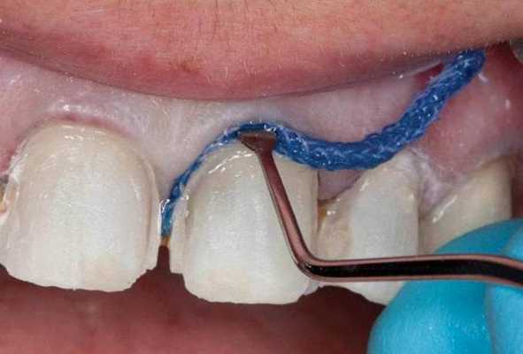 ретракция нитью