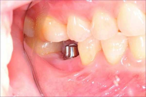 формирование десны