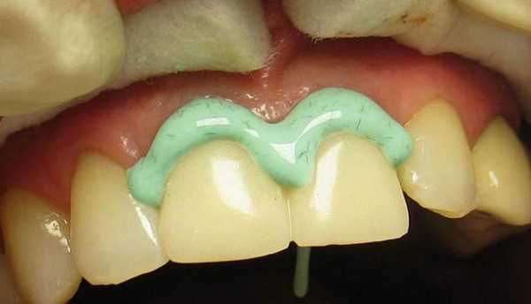 гель для ретракции десны