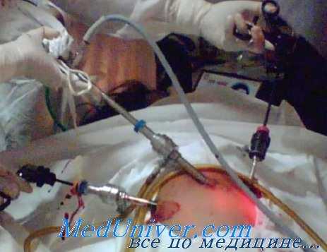 повреждения сосудов брюшной стенки