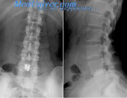 дискэктомия