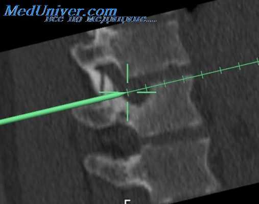 дискэктомия в нейрохирургии