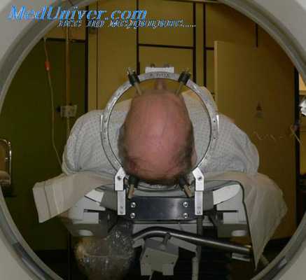 дискэктомия задним доступом