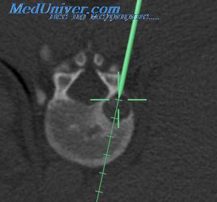 дискэктомия