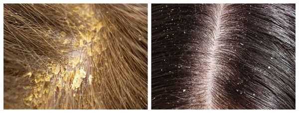 Жирная и сухая себорея