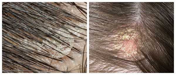 Крупные хлопья перхоти. Небольшие чешуйки вокруг розового пятна