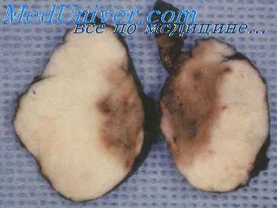 аденома простаты