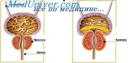 аденома простаты