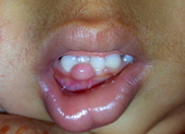 Фиброматозный эпулис [13]