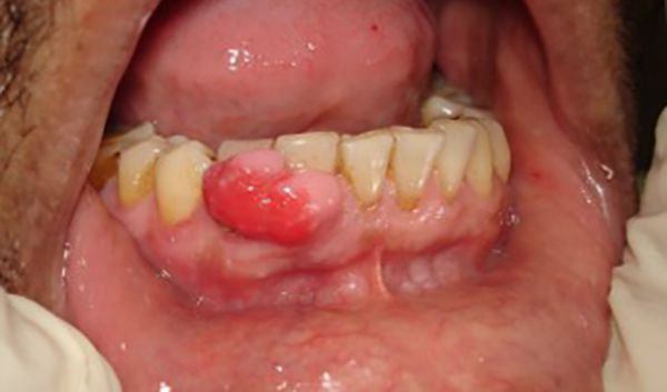 Периферическая гигантоклеточная гранулёма [14]