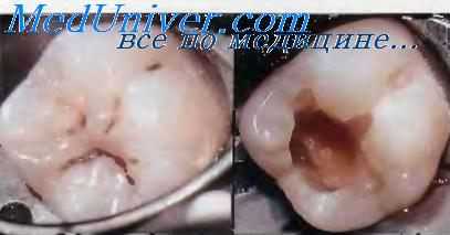 Кариес зубов