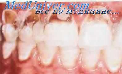 Кариес зубов