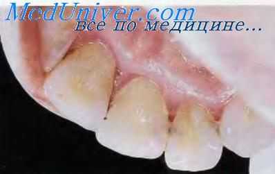 Кариес зубов