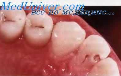 Кариес зубов