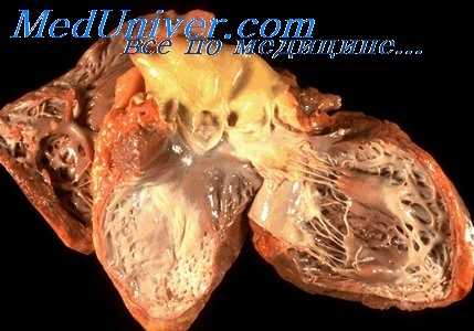 ревматизм при пороке сердца