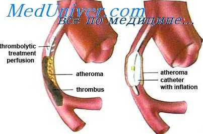 сердце при врожденном пороке