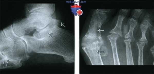 Рентгенограмма, КТ, МРТ при ревматоидном артрите голеностопного сустава и стопы
