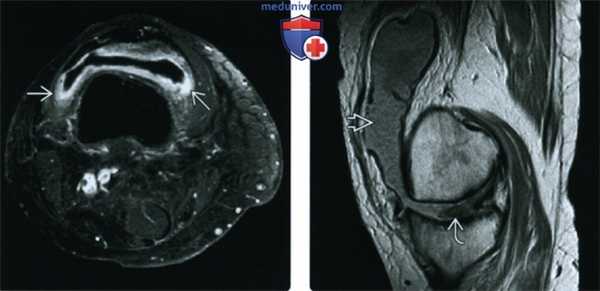 Рентгенограмма, МРТ при ревматоидном артрите коленного сустава