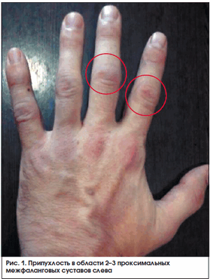 Рис. 1. Припухлость в области 2–3 проксимальных межфаланговых суставов слева
