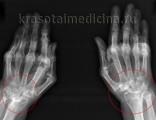 Рентгенография кистей. Поражения суставов при ревматоидном артрите (IV стадия по Штейнброкеру). Костный анкилоз; множественные эрозии суставных поверхностей; подвывих в суставах; остеопороз.