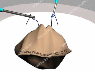 лапароскопическая резекция желудка операция