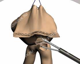 лапароскопическая резекция желудка фото