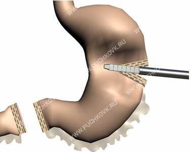 лапароскопическая резекция желудка фото