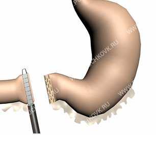 операция гастрэктомия