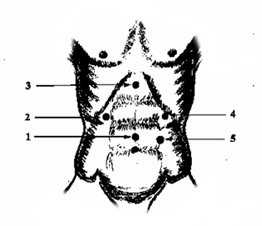 резекция по бильрот 2