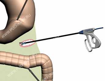  Мобилизация большой кривизны желудка при лапароскопической резекции