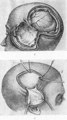 Рис. 4. Схематическое изображение этапов костно-пластической трепанации черепа по методу Вагнера — Вулфа (а) и по методу Оливекруны (б): а — выкроен и отвернут единый кожно-надкостнично-костный лоскут; б — выкроен и отвернут кожно-апоневротический лоскут с широким основанием, наложены трепанационные отверстия, под кость между соседними трепанационными отверстиями проведены проводник Оливекруны (1) и проволочная пила (2).