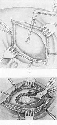 Рис. 2. Схематическое изображение этапов декомпрессивной трепанации черепа: а — наложение фрезевого отверстия в центре освобожденного от мягких тканей участка кости; б — резекция кости костными щипцами.