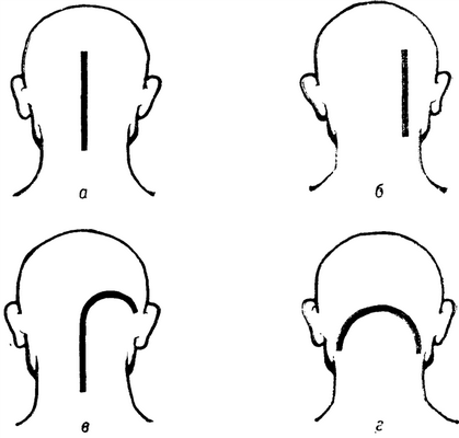 Рис. 3. Схематическое изображение кожных разрезов, применяемых при резекционной трепанации черепа для доступов к различным отделам задней черепной ямки: а — срединный, б — парамедианный, в — полуарбалетный, г — подковообразный.