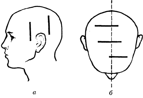 Рис. 6. Схематическое изображение линейных разрезов, применяемых при костнопластической трепанации черепа для доступов к различным отделам головного мозга: а — вертикальные разрезы для доступа к височной и теменной долям; б — горизонтальные разрезы для доступа к лобной, теменной и затылочной долям; пунктиром обозначена сагиттальная плоскость.