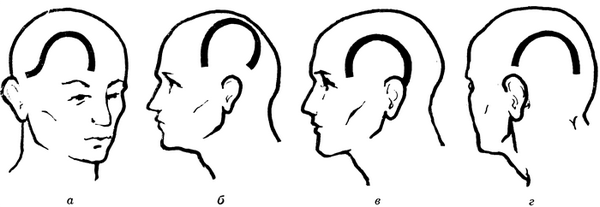 Рис. 5. Схематическое изображение дугообразных кожных разрезов, применяемых при костно-пластической трепанации черепа для доступов к различным отделам головного мозга: а - разрез для доступа к лобной доле; б — разрез для доступа к теменной доле; в — разрез для доступа к височной доле; г — разрез для доступа к затылочной доле.