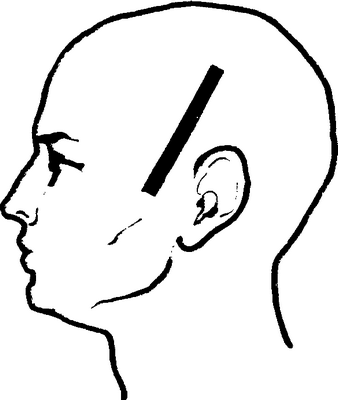 Рис. 1. Схематическое изображение кожного разреза (обозначен жирной черной линией) в височной области при декомпрессивной трепанации черепа: разрез проходит от середины верхнего края скуловой дуги до теменного бугра.