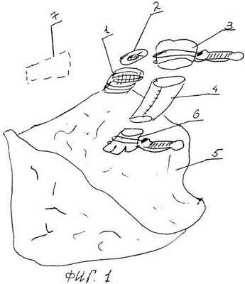 Способ верхней лобэктомии слева при опухолях легкого