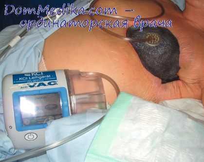 верхняя лобэктомия