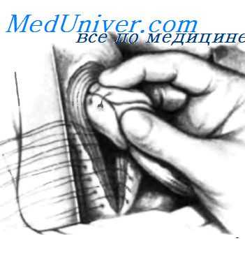 операции при укорочении пищевода