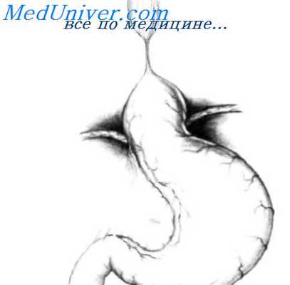 резекция пищевода