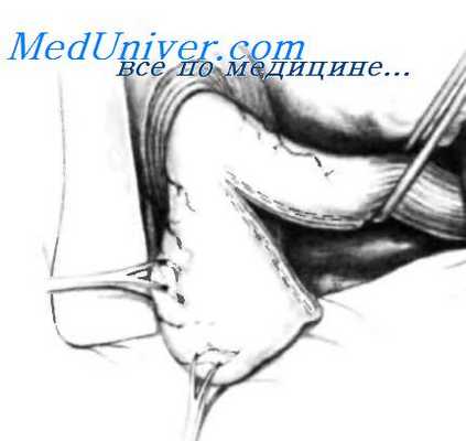 операции при укорочении пищевода