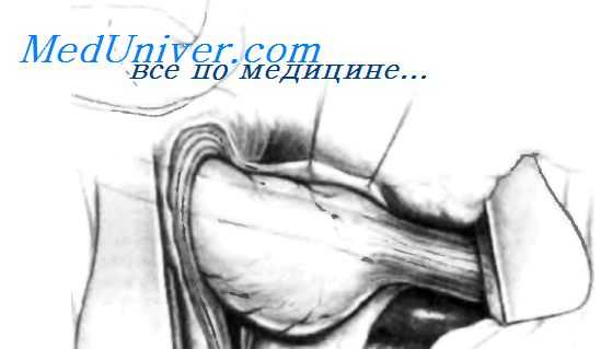 операции при укорочении пищевода