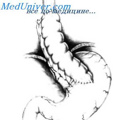 техника резекции пищевода