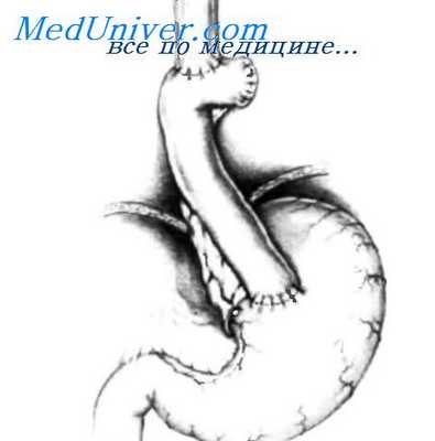 резекция пищевода