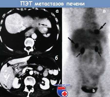 ПЭТ при метастазах опухолей в печень