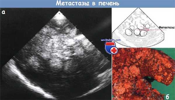 Метастазы опухолей в печень