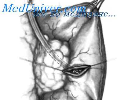 дивертикулы двенадцатиперстной кишки