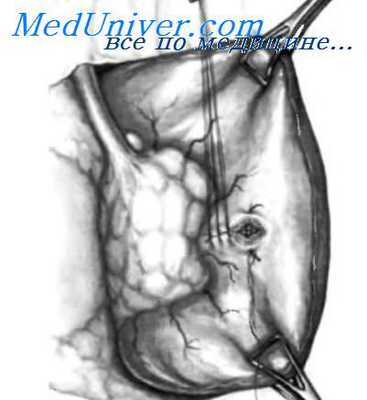 дивертикулы двенадцатиперстной кишки