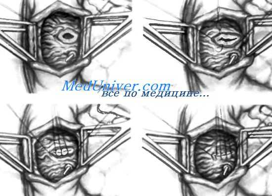 дивертикулы двенадцатиперстной кишки